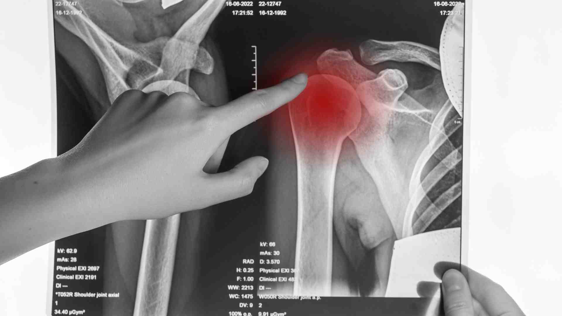 Rotator Cuff Injury